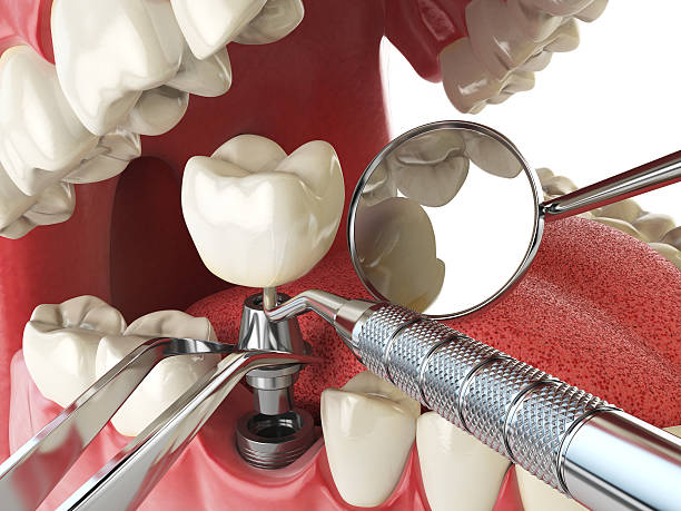 Best Knocked-Out Tooth Emergency  in Shelton, WA